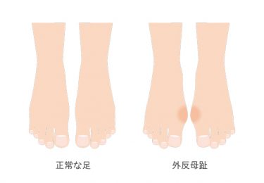 靴だけじゃない？外反母趾の本当の原因と解決のヒント
